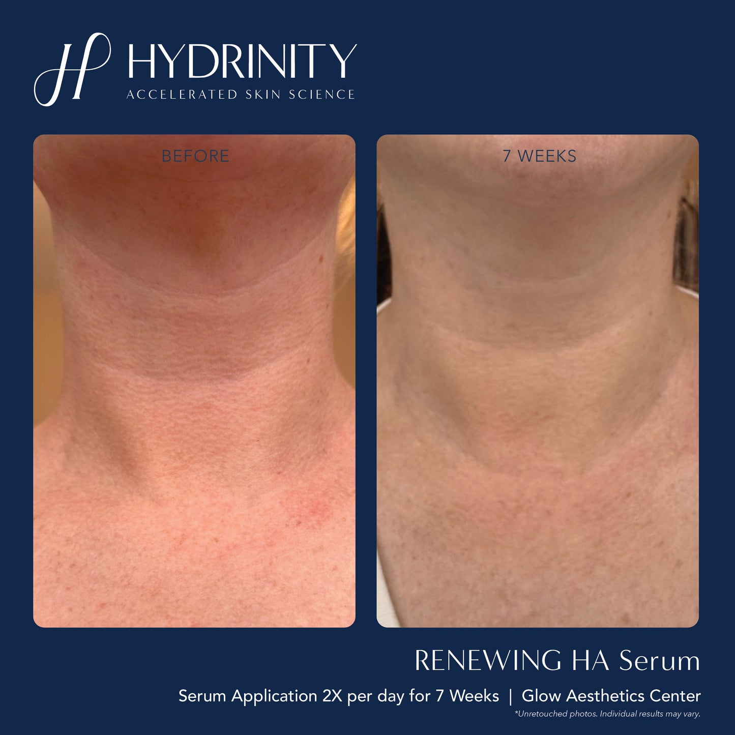 Renewing HA serum