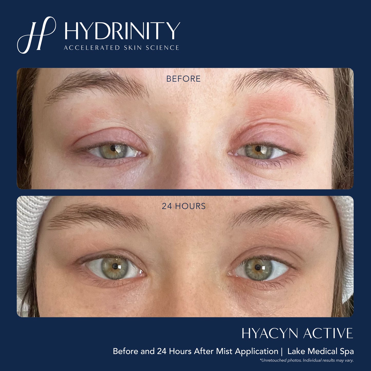 Hyacyn Active