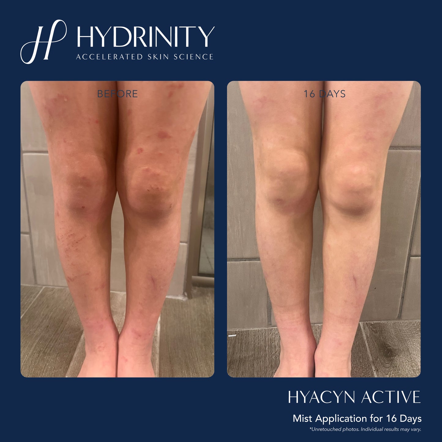 Hyacyn Active